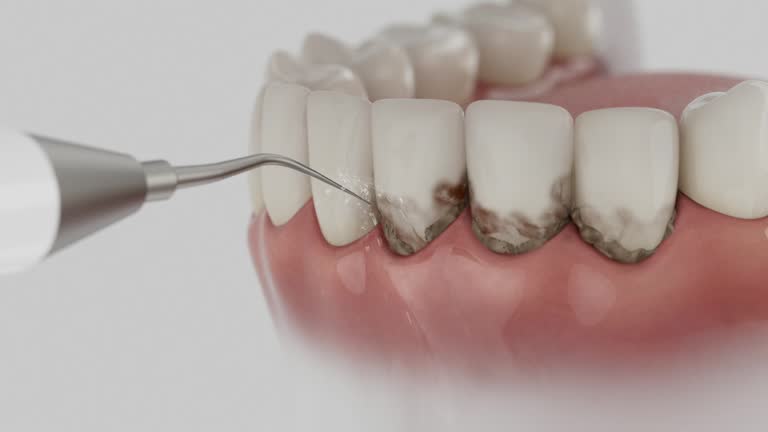 Trusted Wisdom Tooth Removal service in Lincoln, MT - Dentist Open Now